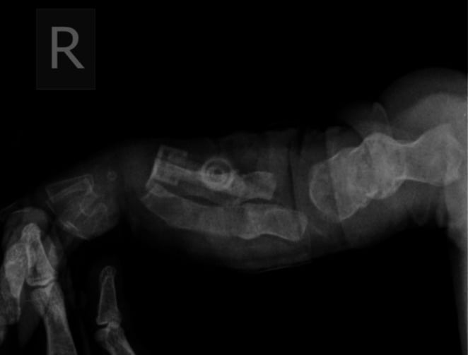 AP radiograph of upper extremity demonstrating multiple fractures of varying ages