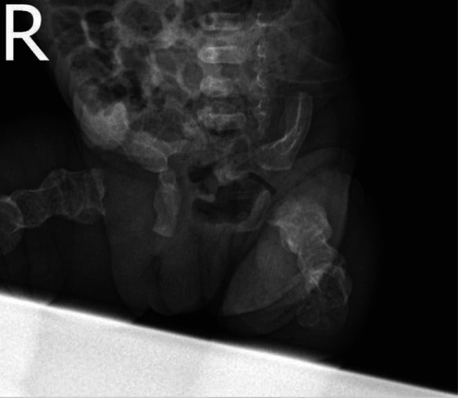 AP radiograph of lower extremities demonstrating multiple fractures of varying ages