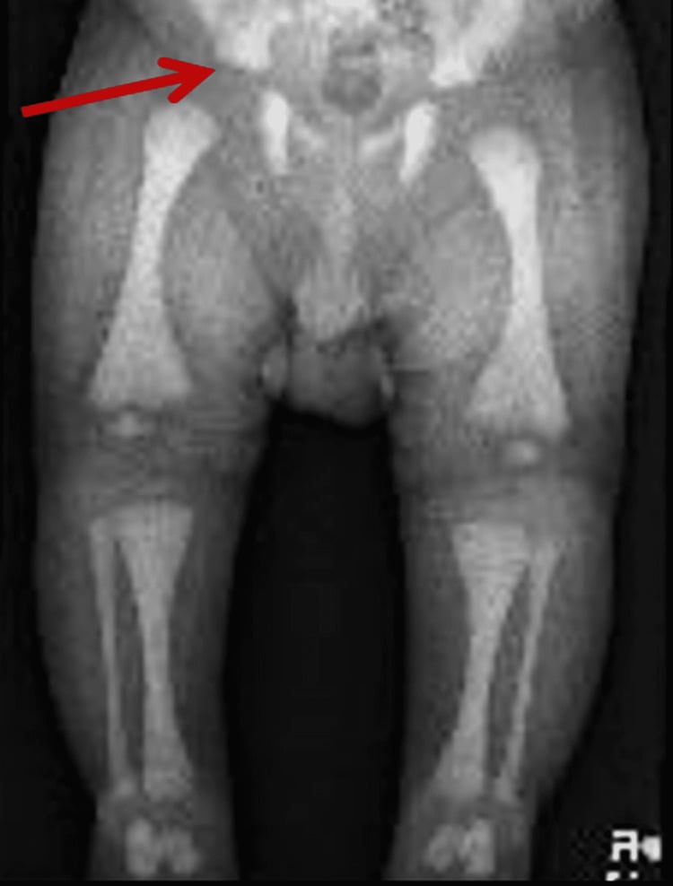 Pelvis and long-bone radiograph showing bone-within-bone appearance and diffuse osteopetrosis