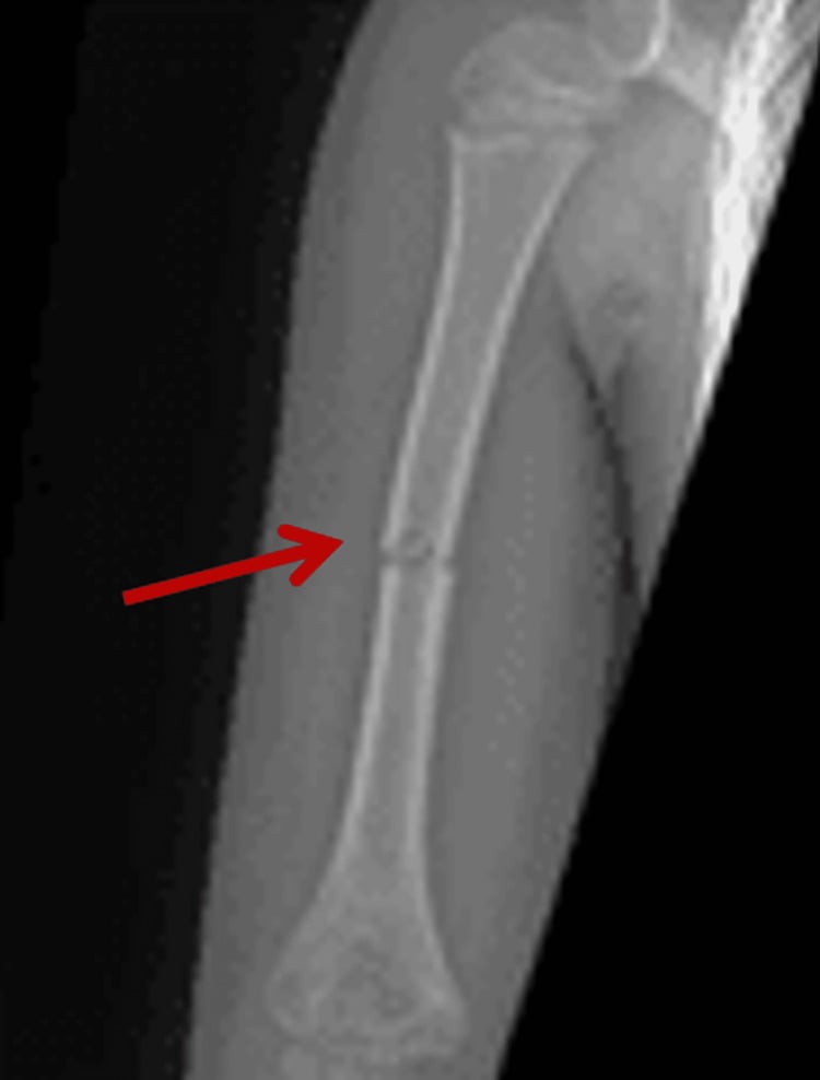 Humerus radiograph showing fracture through dense osteopetrotic bone