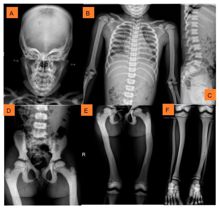 Skull chest spine hand and limb radiographs showing pycnodysostosis