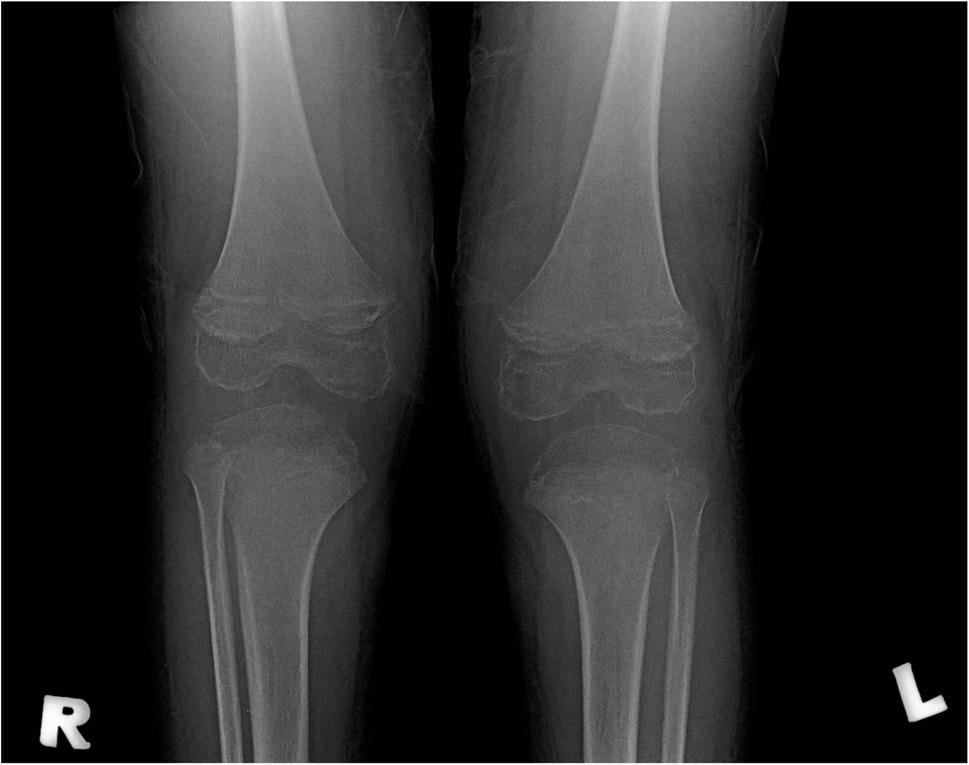 Bilateral knee radiographs showing osteopenia and epiphyseal enlargement in paediatric scurvy
