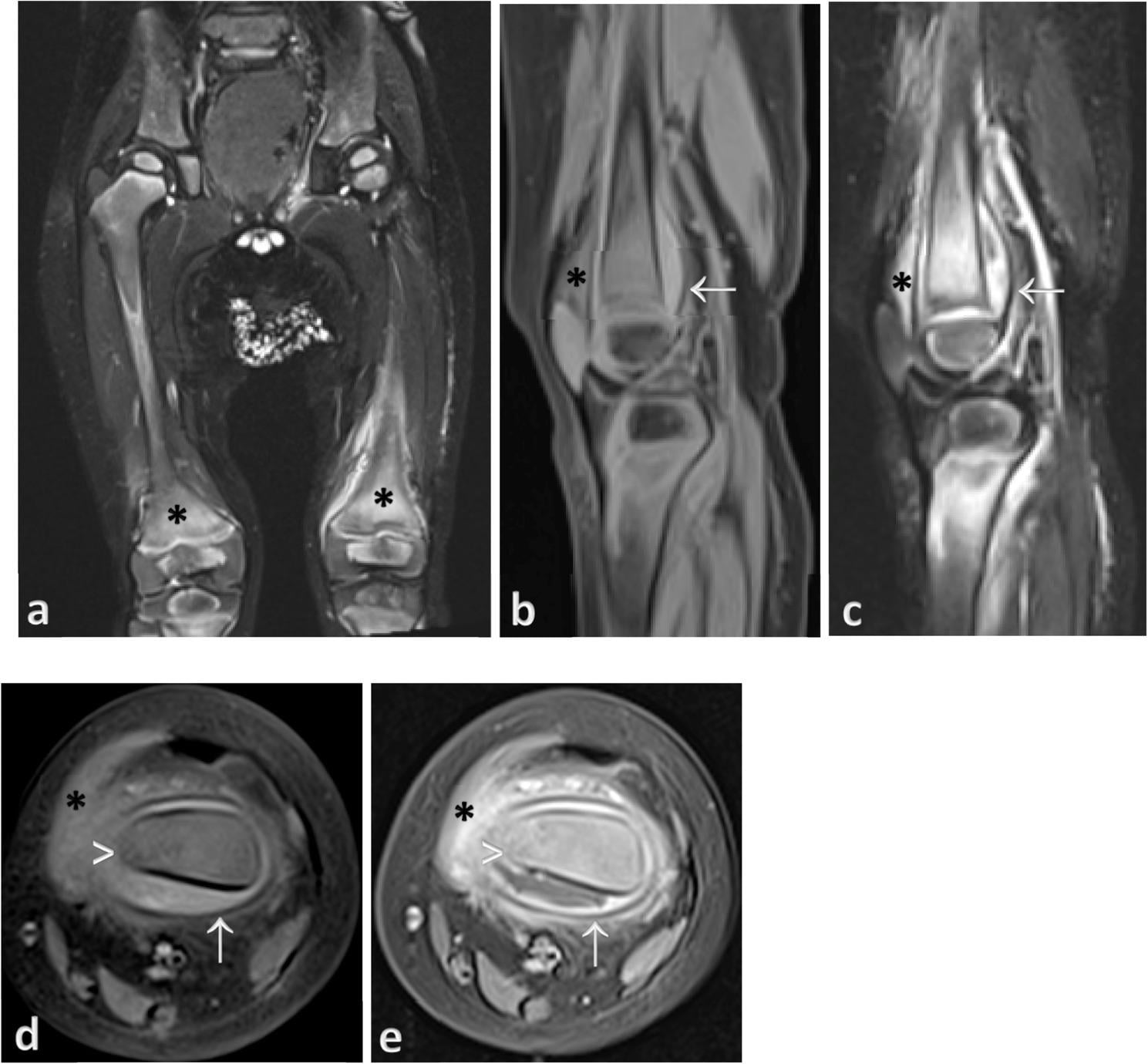 Knee MRI showing marrow oedema and subperiosteal haemorrhage in paediatric scurvy