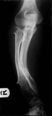 Forearm radiograph showing shortening of the ulna with secondary bowing of the radius due to multiple osteochondromas