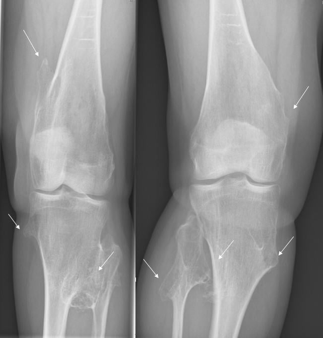 AP radiographs of both knees showing multiple osteochondromas arising from the metaphyses in multiple hereditary exostoses.