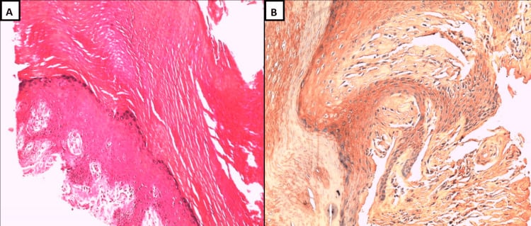 Nail-bed histopathology showing amorphous eosinophilic deposits in the papillary dermis on haematoxylin and eosin with Congo red staining alongside