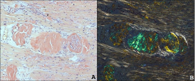 Myocardium with extensive interstitial amyloid deposits staining brick-red on Congo red and showing apple-green birefringence under polarised light