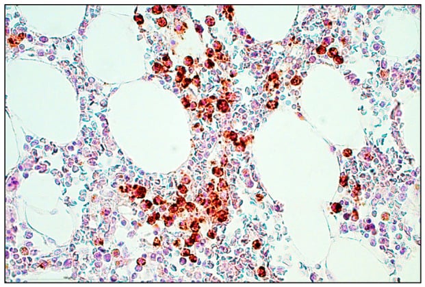 Bone marrow immunohistochemistry showing dense CD138-positive myeloma plasma cells among marrow fat