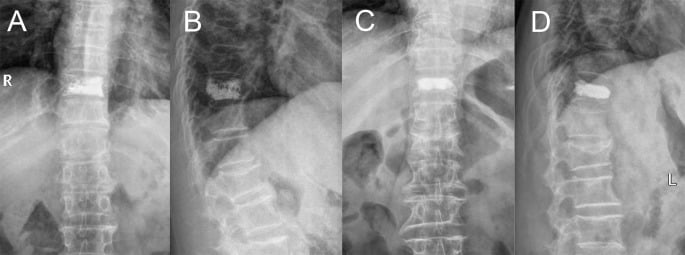 Anteroposterior and lateral radiographs contrasting a trabecular interdigitating cement pattern with a compact cement mass