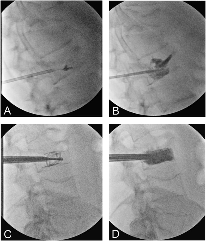 Lateral fluoroscopic images showing transpedicular needle placement, balloon inflation and cement delivery during kyphoplasty of a vertebral fracture
