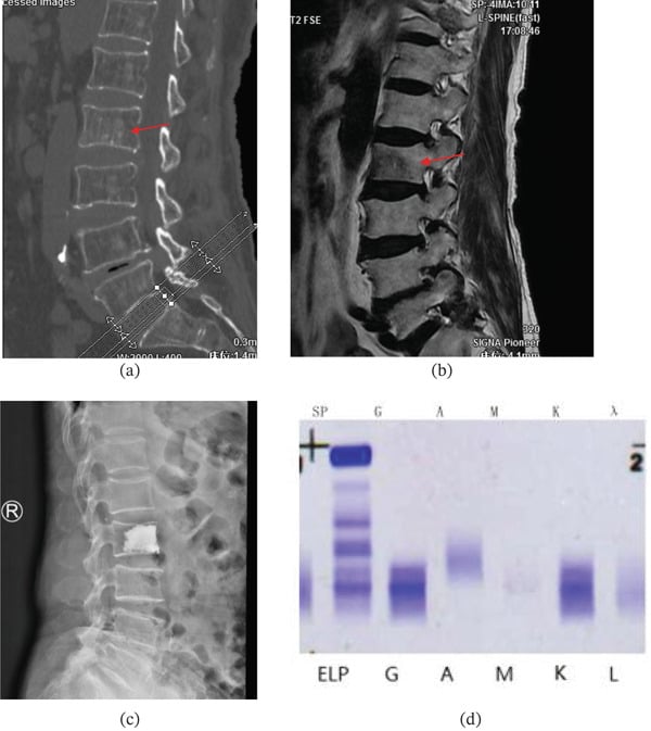 Sagittal CT showing no obvious bone destruction, MRI showing marrow signal change, a radiograph after augmentation, and serum protein electrophoresis with a monoclonal band