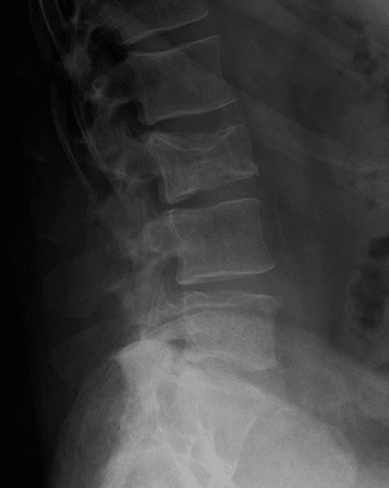 Lateral lumbar radiograph in multiple myeloma showing a pathological vertebral compression fracture with reduced body height and background osteopenia.