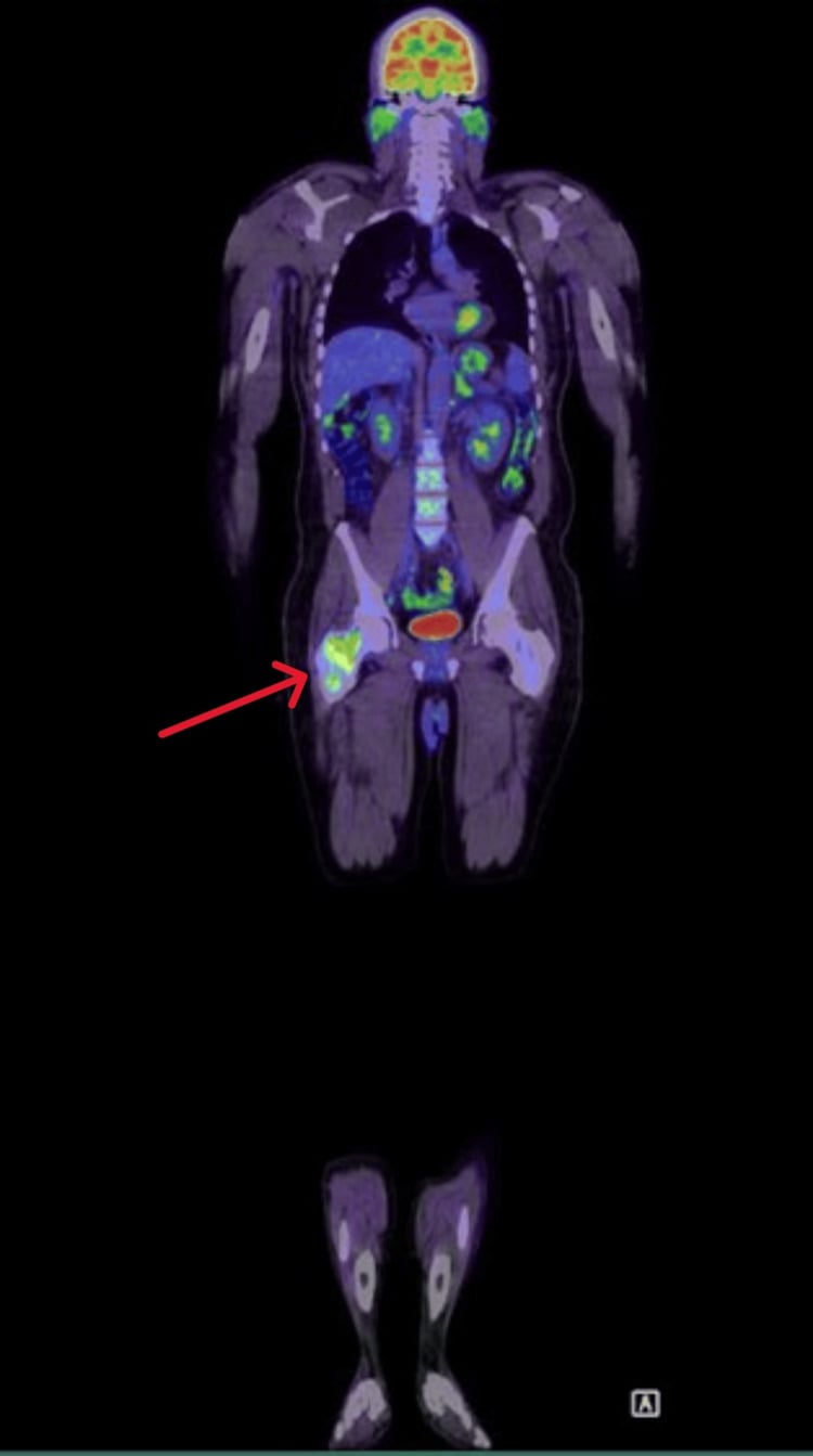 Whole-body PET maximum intensity projection showing a solitary destructive lesion in the right femoral neck with markedly increased metabolic activity
