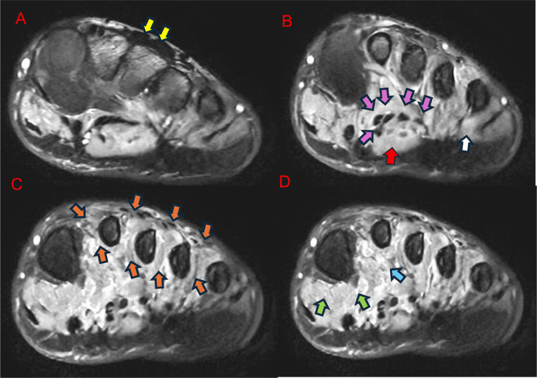 Fat-suppressed MRI showing acute denervation oedema in intrinsic foot muscles