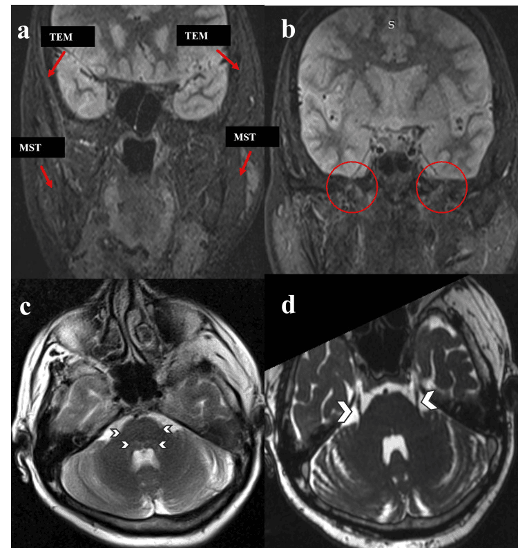 MRI showing chronic denervation of the left masticatory muscles