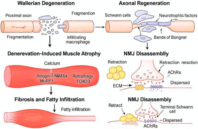 Schematic of Wallerian degeneration leading to denervation-induced muscle atrophy, fibrosis and fatty infiltration, and of axonal regeneration along Schwann cells and bands of Büngner with neuromuscular junction disassembly and dispersed acetylcholine receptors