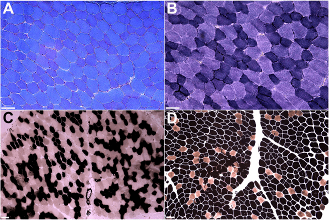 Four histochemical sections of a muscle biopsy, panels A to D with scale bars, showing type I fibre predominance