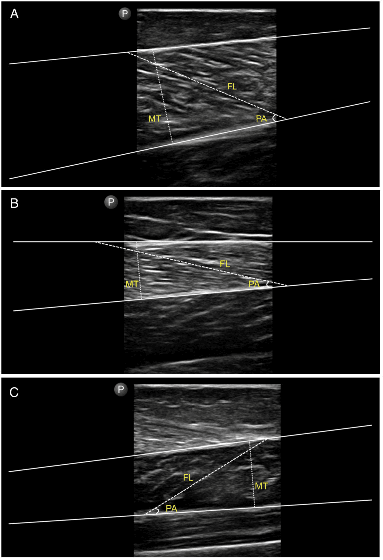Three longitudinal ultrasound images, panels A to C, with the aponeuroses traced and fascicle length (FL), pennation angle (PA) and muscle thickness (MT) marked