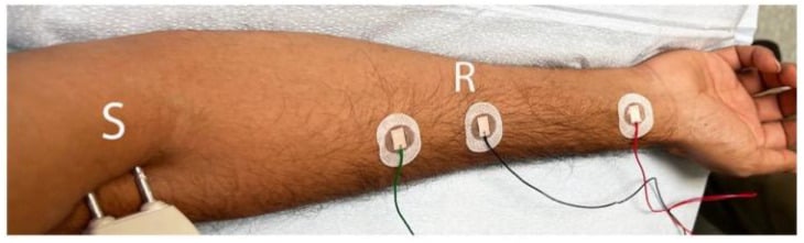 Forearm electrode arrangement for lateral antebrachial cutaneous nerve conduction testing with stimulating, recording and reference electrodes.