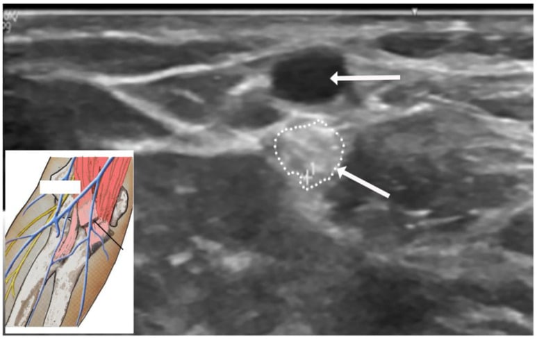 Ultrasound showing an enlarged hyperechoic lateral antebrachial cutaneous nerve adjacent to the cephalic vein after phlebotomy.