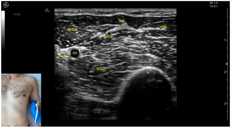 Transverse ultrasound of biceps brachii showing the short and long heads, musculocutaneous branch, brachialis, median nerve, brachial artery and humerus.