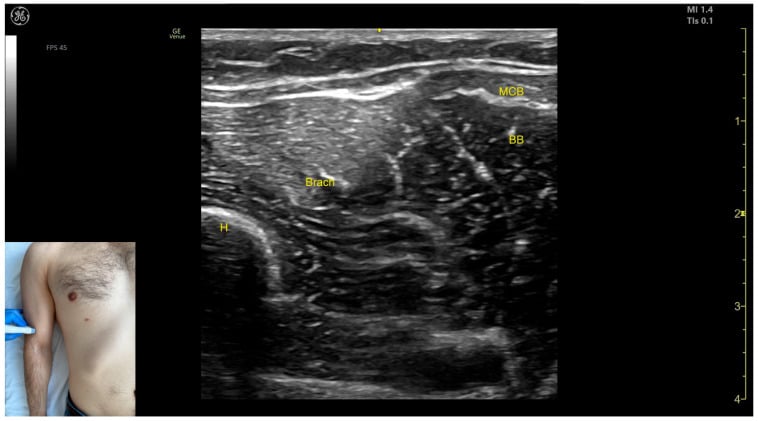 Transverse distal-arm ultrasound labelling brachialis, biceps brachii, humerus and the musculocutaneous branch.