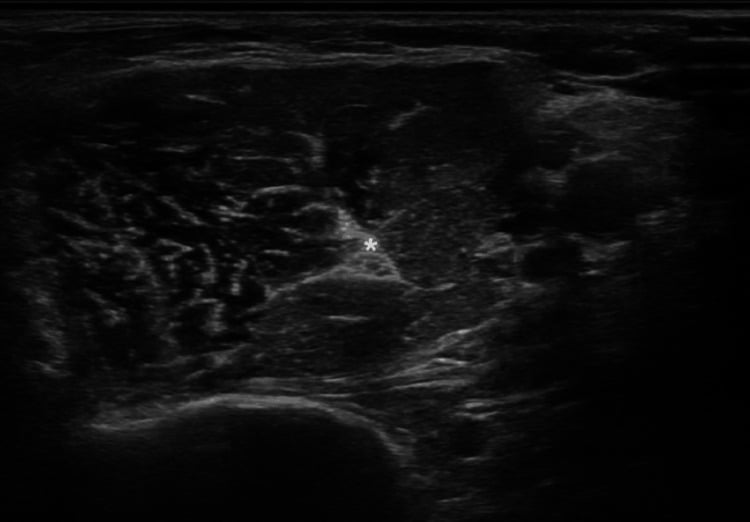 Transverse ultrasound showing the musculocutaneous nerve within the coracobrachialis muscle.