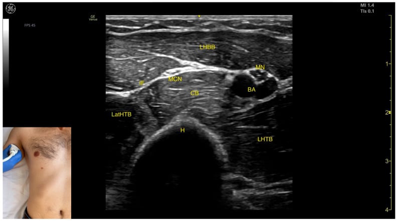 Transverse upper-arm ultrasound labelling the musculocutaneous nerve beside the long-head biceps, coracobrachialis, median nerve, brachial artery, humerus and triceps heads.