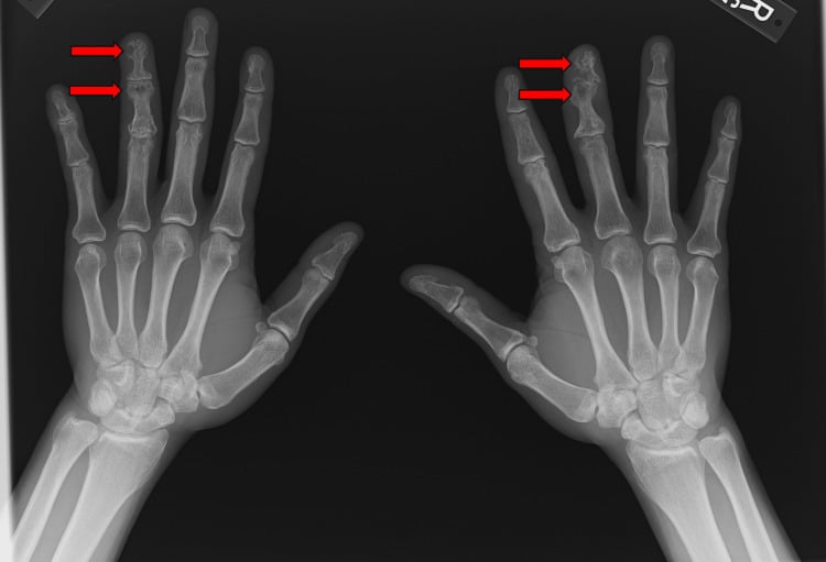 Bilateral hand radiographs showing the lace-like reticular lytic pattern of osseous sarcoidosis in the phalanges