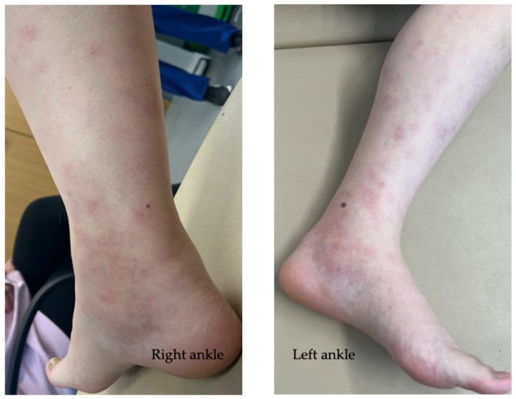 Clinical photograph demonstrating ankle swelling and erythema nodosum in Löfgren syndrome