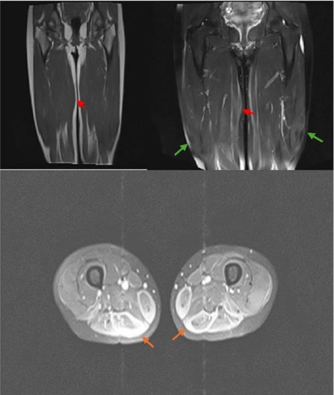 Coronal T1/T2 MRI and axial CT demonstrating muscular sarcoidosis and dark-star sign