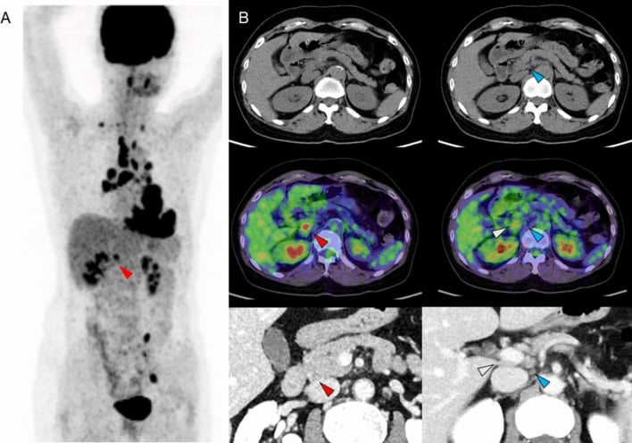 Whole-body 18F-FDG PET-CT scans demonstrating FDG uptake in sarcoidosis