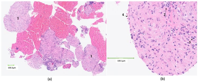 H&E histology slide demonstrating non-caseating granulomas in sarcoidosis
