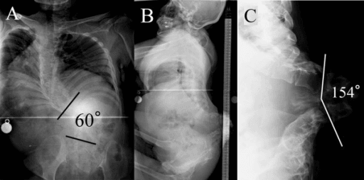 Spinal deformity radiographs in myelomeningocele