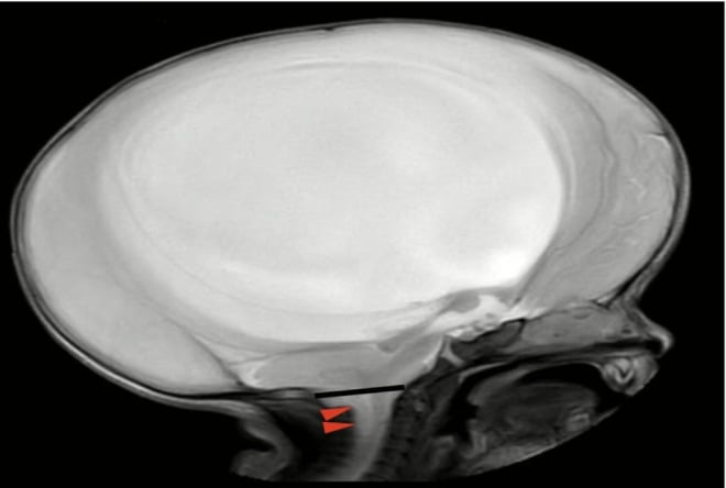 Sagittal T2 MRI showing the crowded posterior fossa and hindbrain descent of Chiari II malformation in myelomeningocele