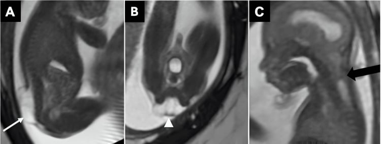 Sagittal and coronal fetal T2 MRI showing an open myelomeningocele placode and Chiari II hindbrain changes