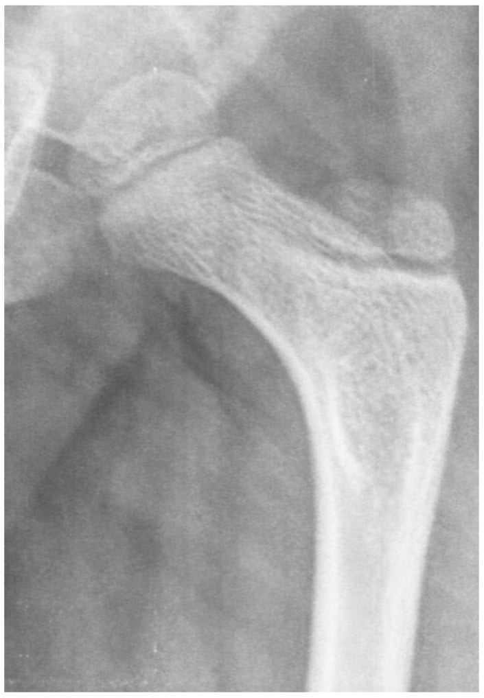 Hip radiograph in thoracic-level myelomeningocele showing an infantile femoral neck-shaft angle and a very shallow acetabulum