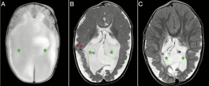Serial axial T2 brain MRI showing hydrocephalus before and after ventriculoperitoneal shunting in Chiari II myelomeningocele