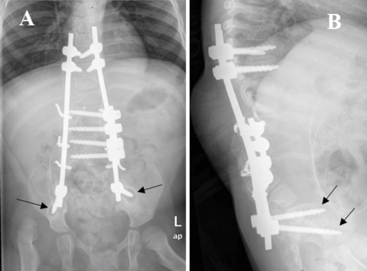 Postoperative AP and lateral radiographs after kyphectomy with combined anterior and posterior instrumentation in myelomeningocele