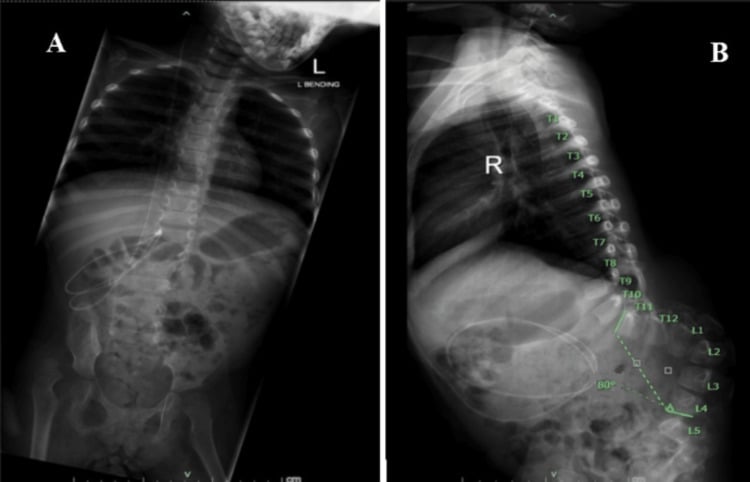 Preoperative AP and lateral whole-spine radiographs showing severe 80 degree thoracolumbar kyphosis in myelomeningocele