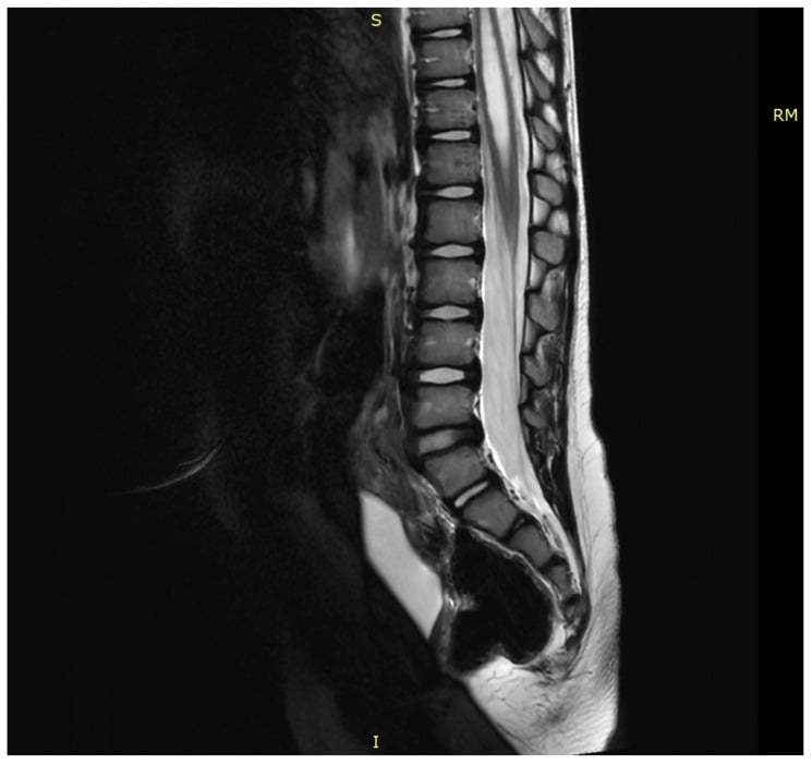 Sagittal T2 lumbar spine MRI showing a low-lying conus from tethered cord syndrome with associated syringomyelia