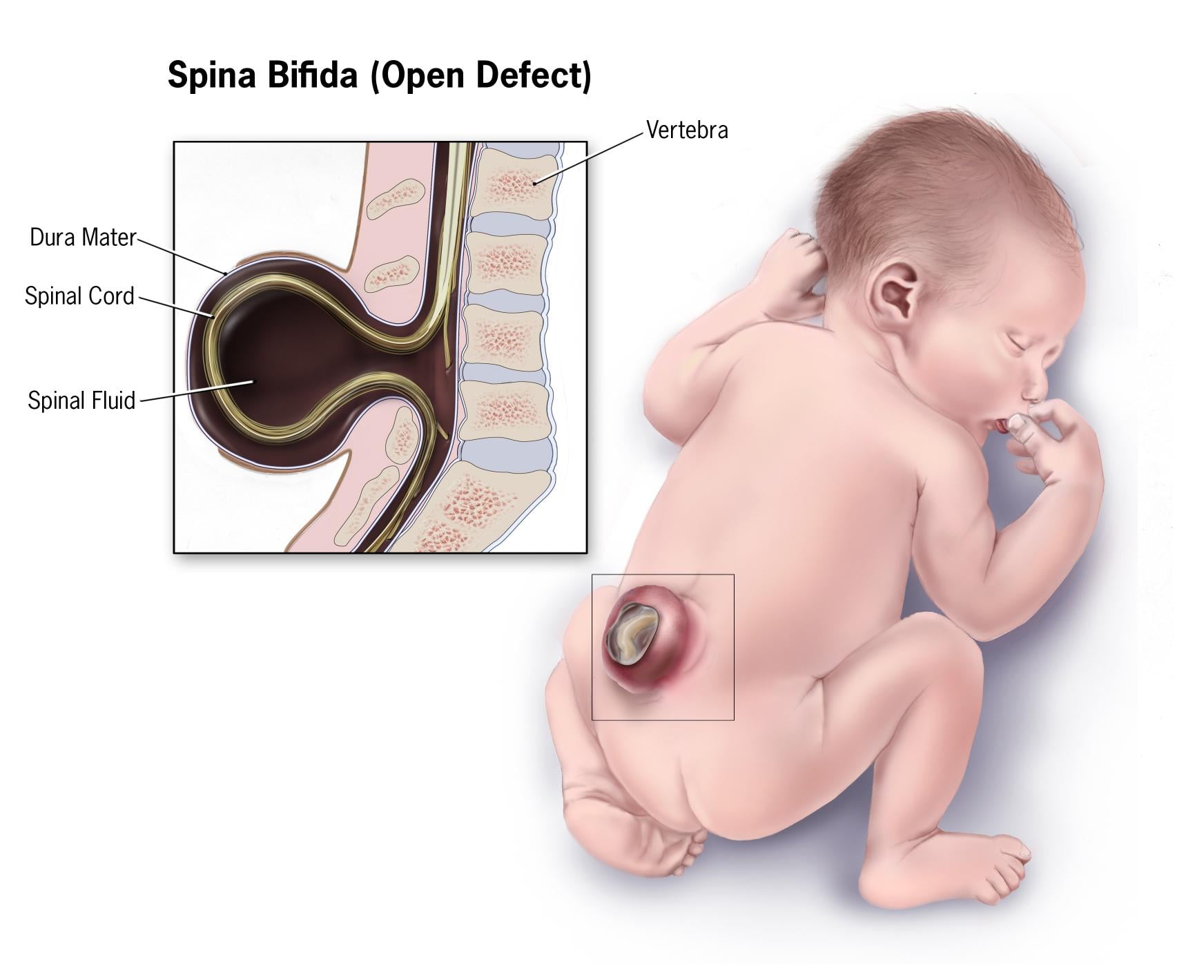 Medical illustration of open spina bifida (myelomeningocele) showing the protruding meningeal sac and exposed neural tissue