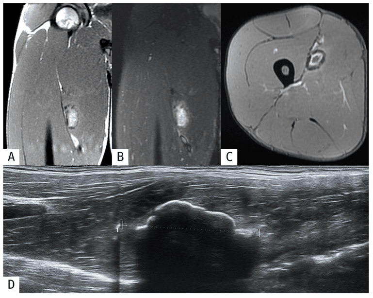 MRI (panels A-C) and ultrasound (panel D) of post-traumatic adductor longus myositis ossificans