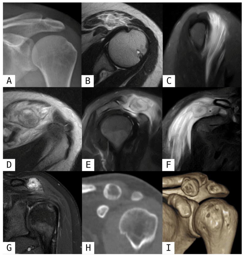Radiograph, MRI and CT of deltoid myositis ossificans from early oedema to ossification