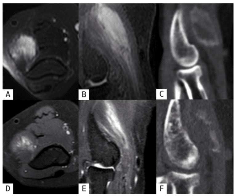 MRI and CT showing evolving elbow-region myositis ossificans