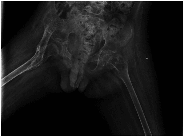 Radiograph showing mature strip-like iliopsoas myositis ossificans across the hip