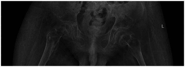 Postoperative pelvic radiograph showing no recurrence after iliopsoas myositis ossificans excision