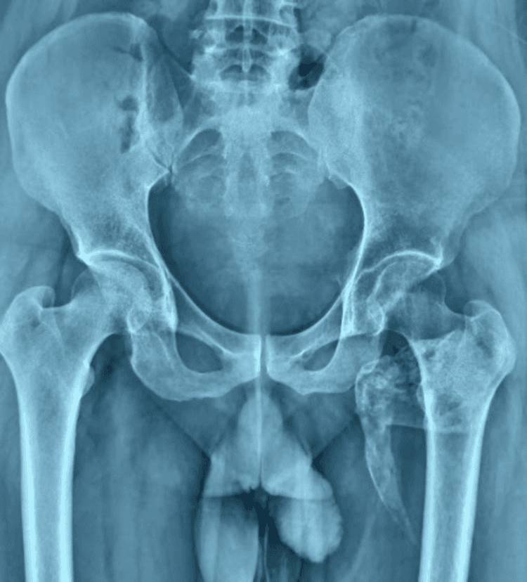 Pelvic radiograph showing a large irregular ossified mass adjacent to the proximal femur
