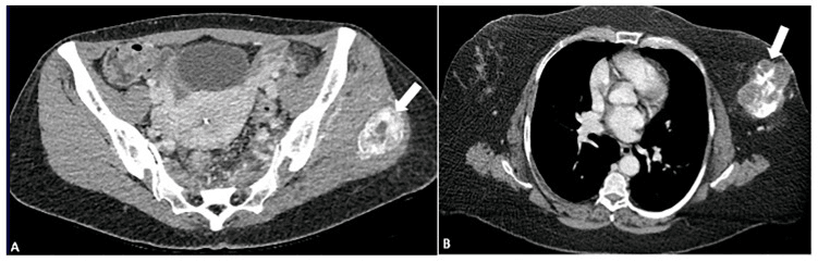 CT comparison of peripheral zoning in myositis ossificans and central mineralization in osteosarcoma