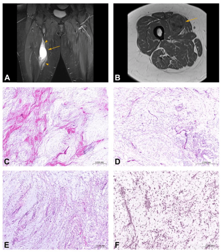 Coronal T1-weighted MRI of an intramuscular myxoma of the thigh with perilesional oedema along the muscle fascia